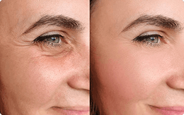 Facial Treatment After